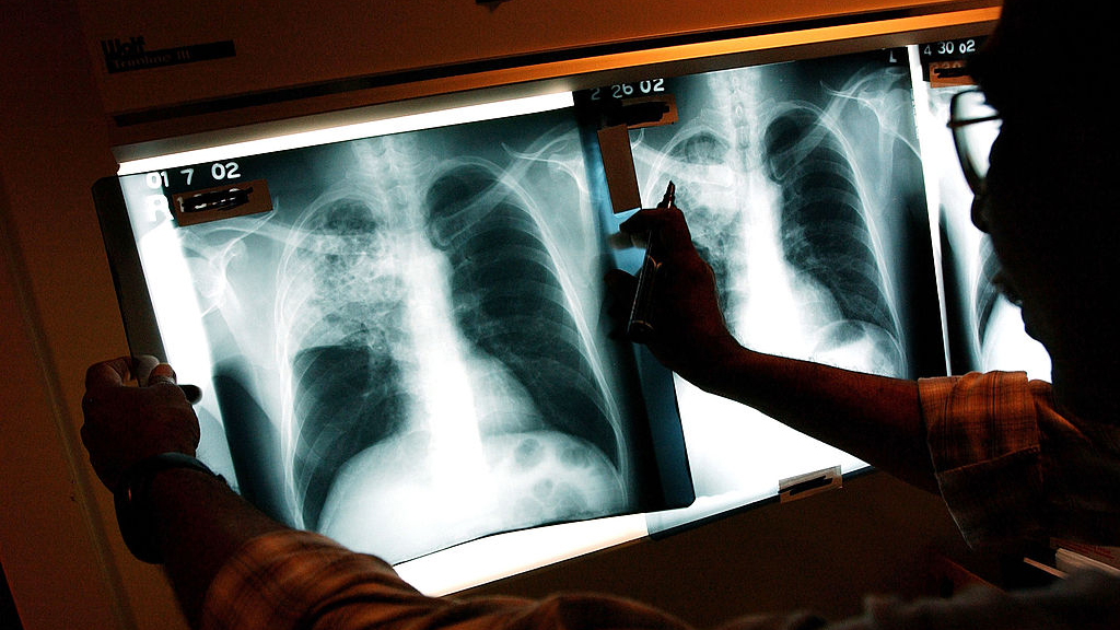 2 active tuberculosis cases traced to San Francisco strip club — KTVU FOX 2 Bay Area, Cupertino Health news